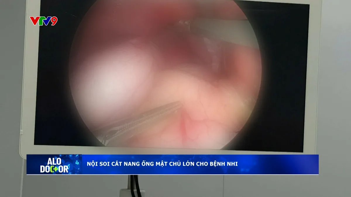 Alo Doctor (17/6/2025): Nội soi cắt nang ống mật chủ lớn cho bệnh nhi Alo Doctor (17/6/2025): Nội soi cắt nang ống mật chủ lớn cho bệnh nhi