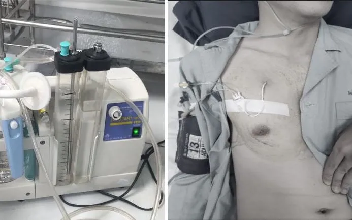 Bệnh nhân được đặt catheter dẫn lưu khoang màng phổi. Ảnh: BVCC