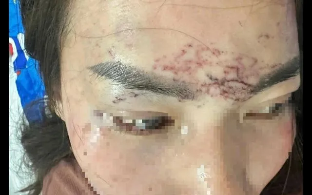 Vết thương trên vùng trán của bà M. 