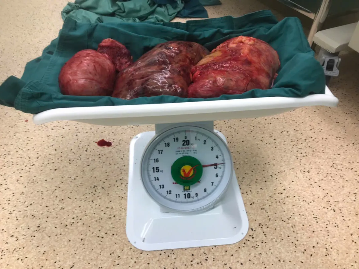 Bệnh viện Vũng Tàu mổ thành công khối u xơ tử cung nặng gần 5kg - Ảnh 1.