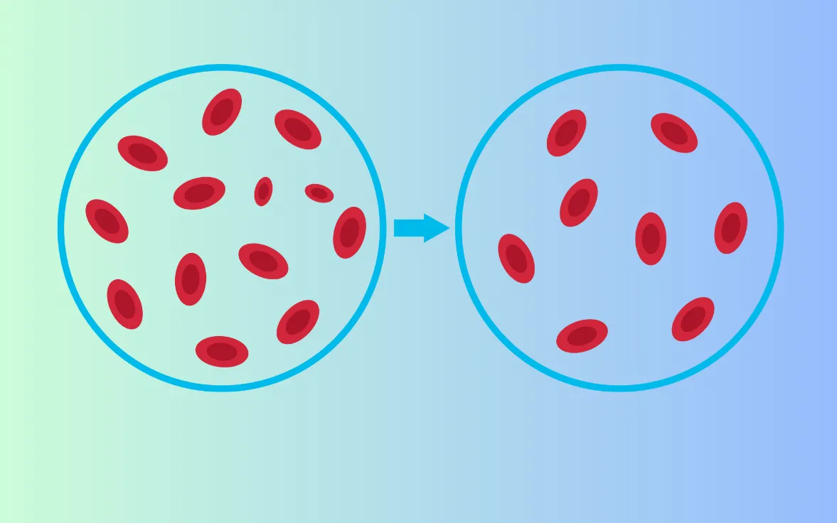 Thalassemia (bệnh tan máu bẩm sinh) có thể gây thiếu máu mức độ nhẹ đến trung bình