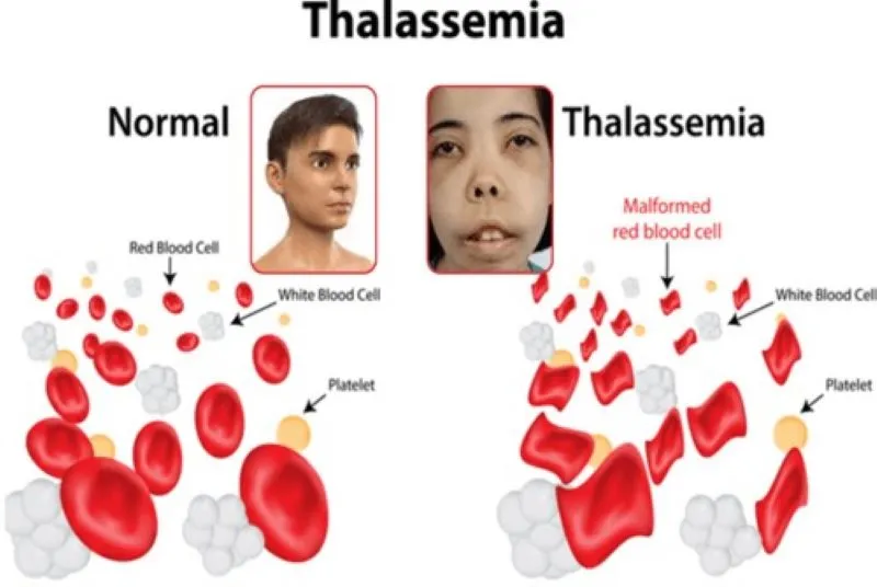 Phát hiện trẻ 19 tháng tuổi mang đột biến gene Thalassemia từ dấu hiệu thiếu máu- Ảnh 1.