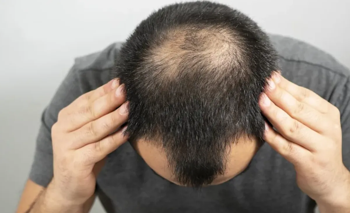 Ph&aacute;t hiện t&igrave;nh cờ c&oacute; thể gi&uacute;p đảo ngược rụng t&oacute;c di truyền m&agrave; kh&ocirc;ng cần thuốc - Ảnh 1.