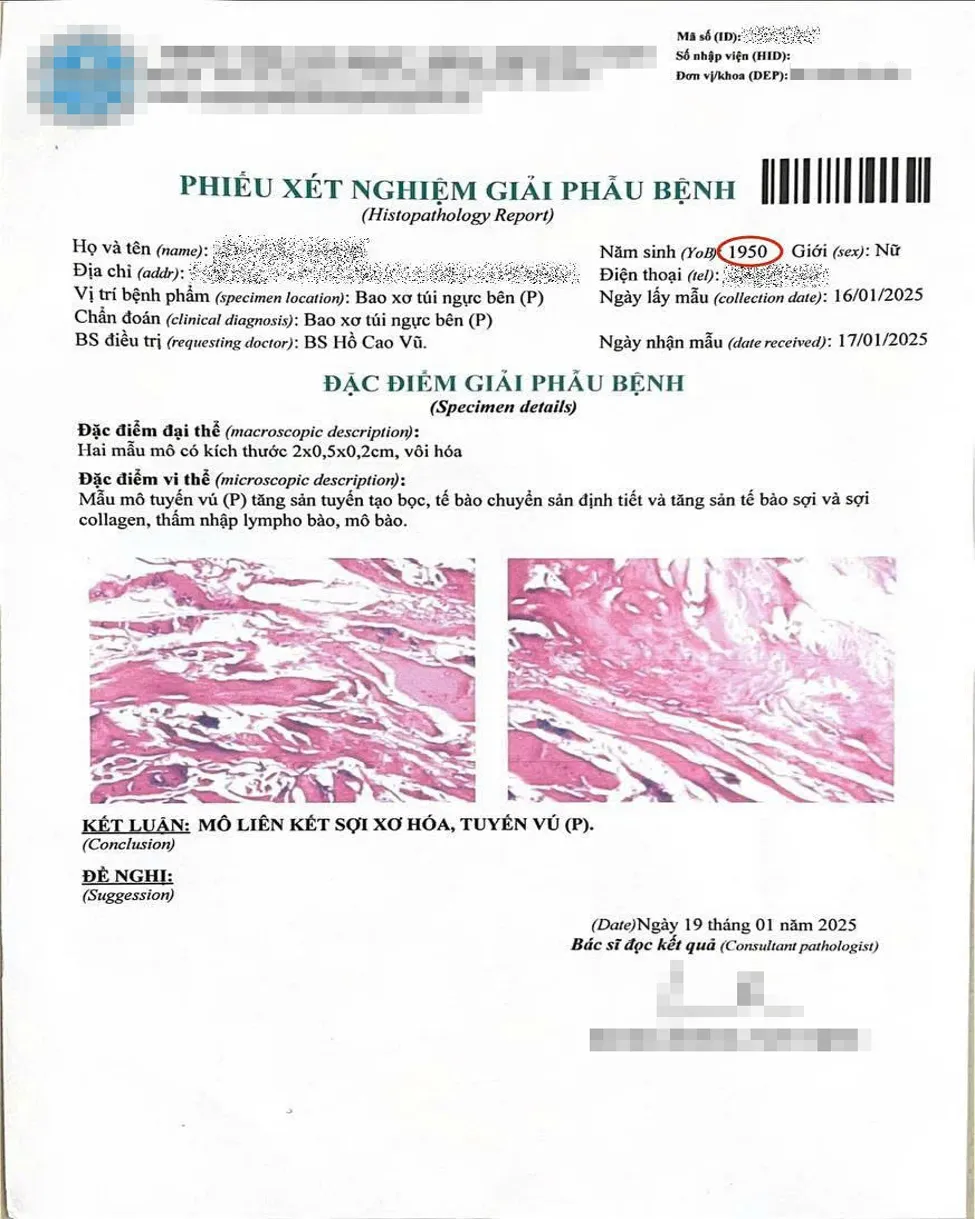 Tháo túi ngực cho phụ nữ có bệnh lý nền - Ảnh 1.