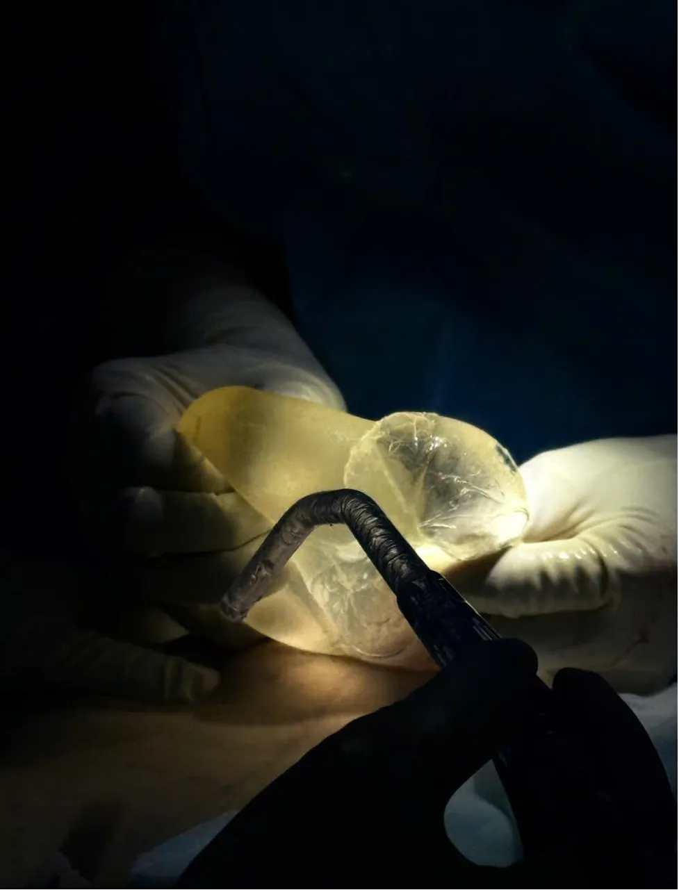 Tháo túi ngực cho phụ nữ có bệnh lý nền - Ảnh 5.