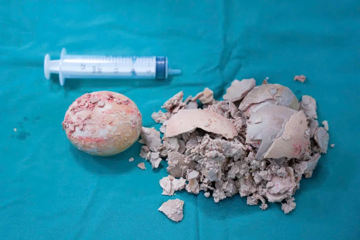 Gia Lai: Phẫu thuật thành công viên sỏi bàng quang "khổng lồ" hơn 10cm - Ảnh 2.