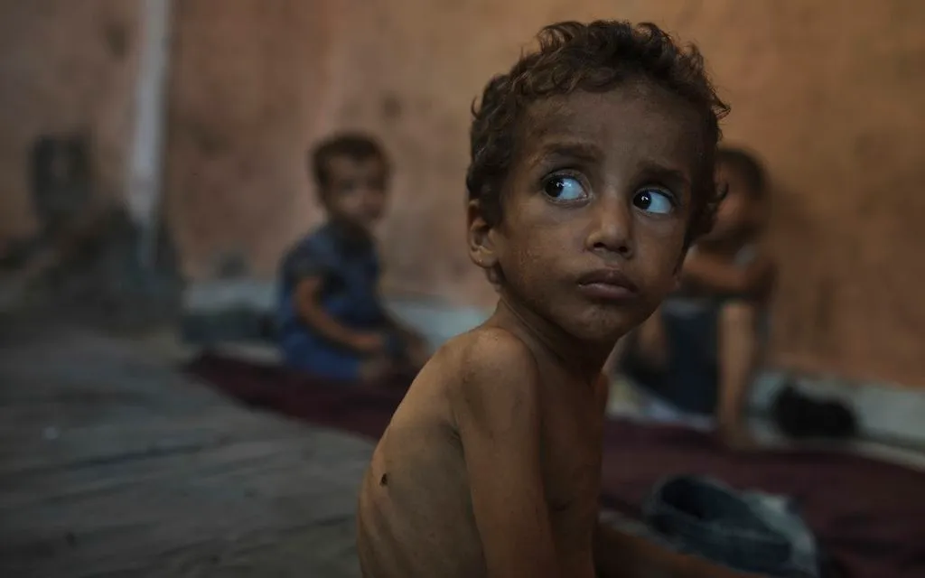 Bé trai 2 tuổi suy dinh dưỡng ngồi trong trại tị nạn Shati ở Gaza, ngày 23/7/2025. (Ảnh: AP)