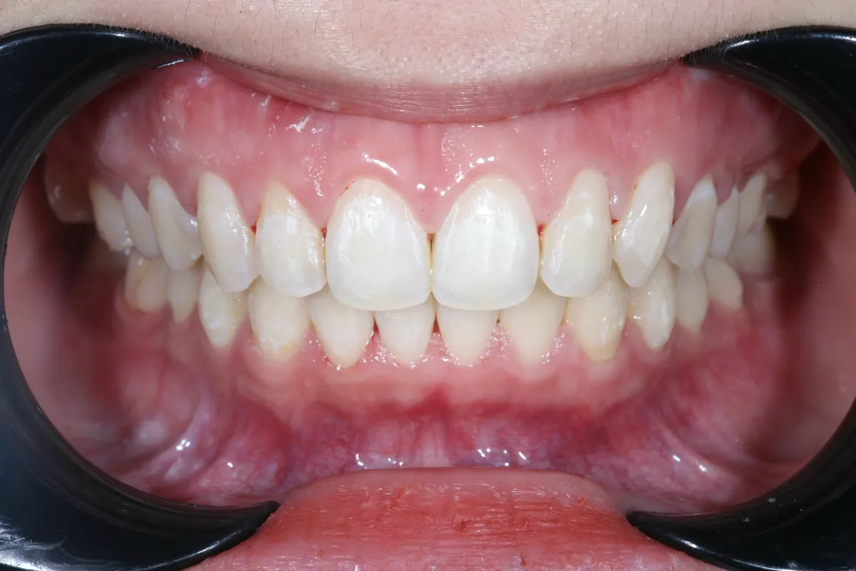 Niềng răng có phải chỉ giải quyết vấn đề thẩm mỹ?- Ảnh 1.