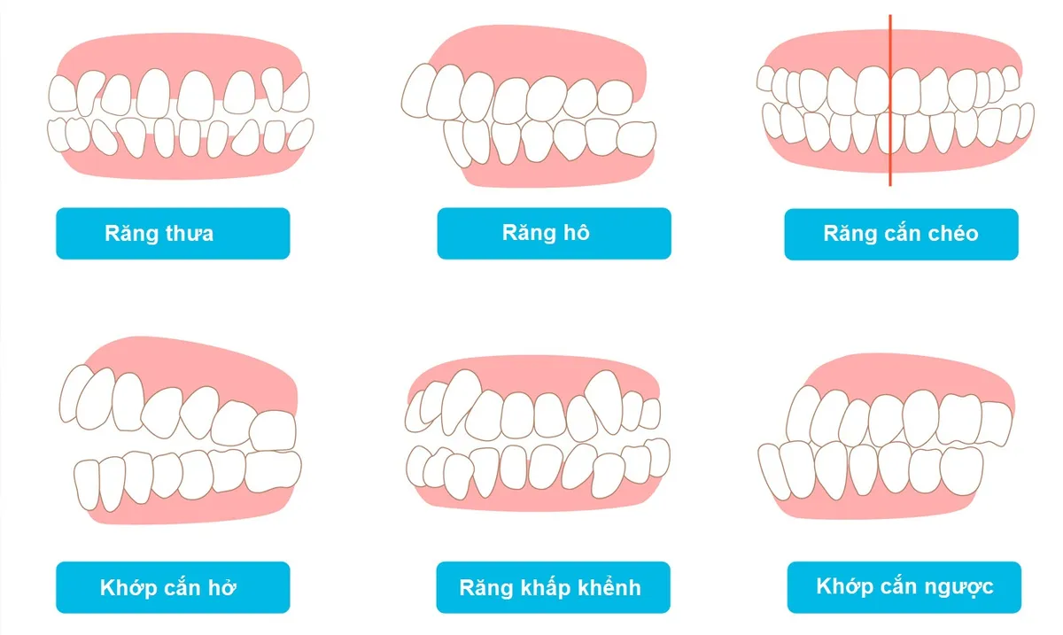Niềng răng có phải chỉ giải quyết vấn đề thẩm mỹ?- Ảnh 2.