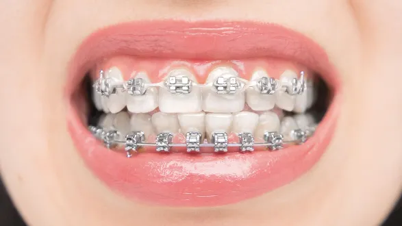Thời gian niềng răng mất bao lâu thì được xem là nhanh? - Ảnh 1.