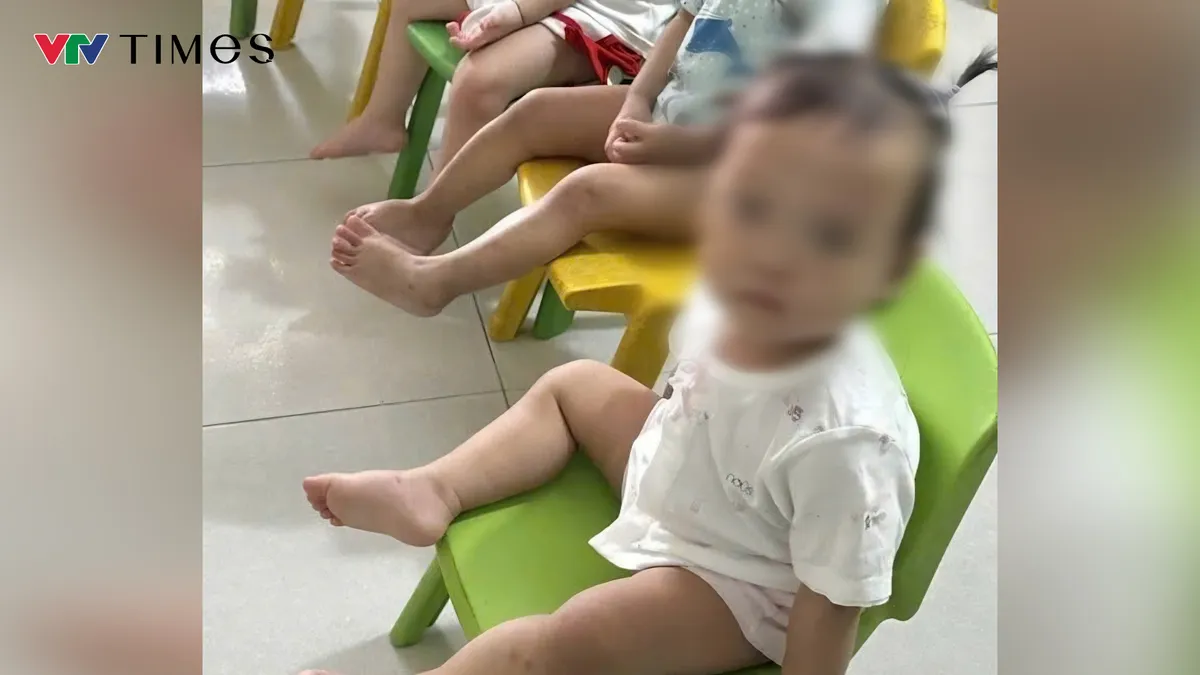 Bé gái 1 tuổi bị bầm tím mặt khi gửi nhà trẻ, Công an Bắc Ninh tạm giữ cô giáo - Ảnh 2.