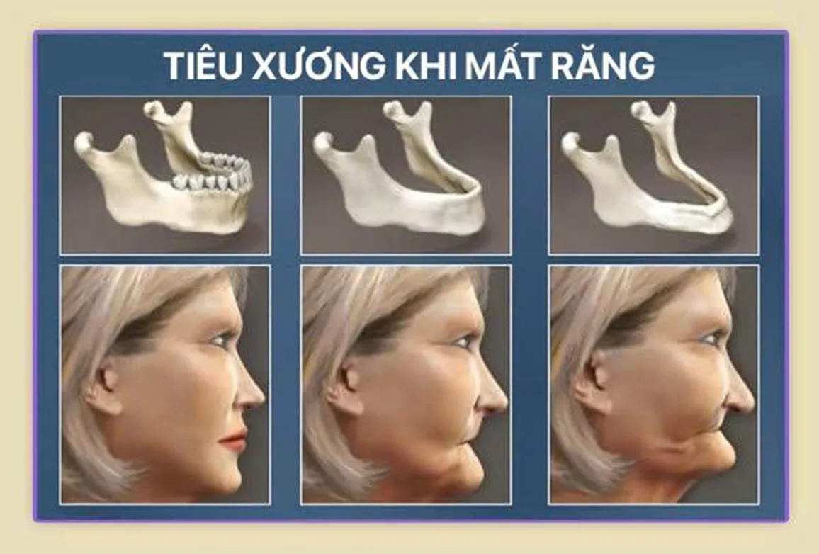 Mất răng ở người cao tuổi: Đâu là giải pháp tốt nhất?- Ảnh 2. Mất răng ở người cao tuổi: Đâu là giải pháp tốt nhất?- Ảnh 2.
