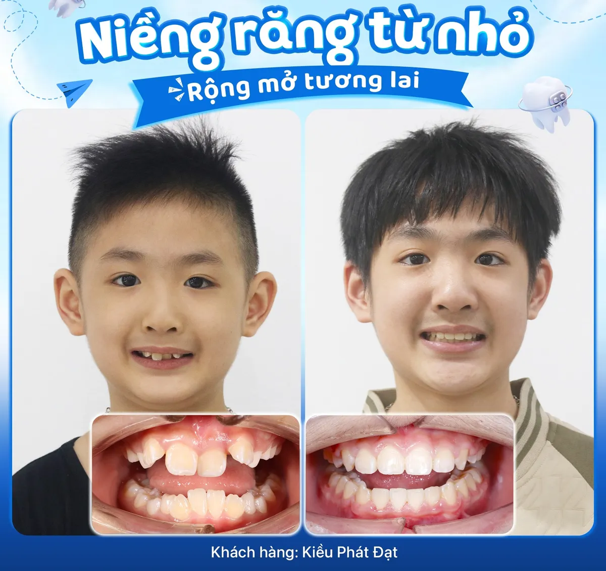 Niềng răng trẻ em: Bí mật về độ tuổi vàng mà cha mẹ không nên bỏ lỡ- Ảnh 2.