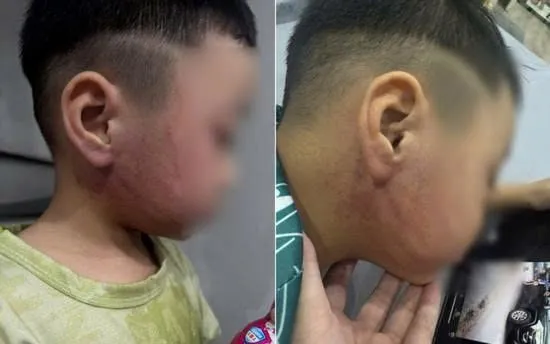 Cháu bé với vết bầm tím trên mặt. Ảnh: Gia đình cung cấp Cháu bé với vết bầm tím trên mặt. Ảnh: Gia đình cung cấp