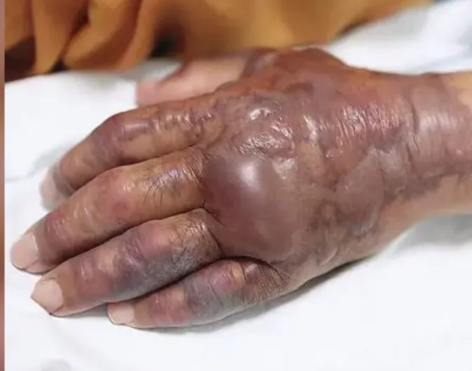 Hàn Quốc khuyến cáo tránh ăn hải sản sống vì "vi khuẩn ăn thịt người" - Ảnh 1.