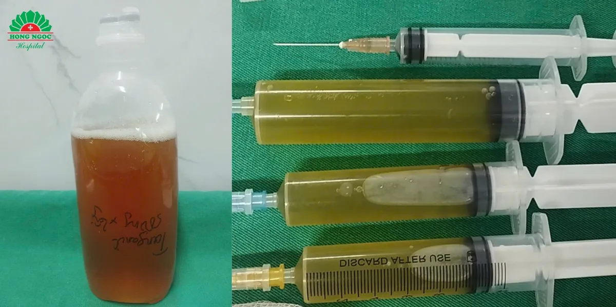 Nguy kịch vì áp xe gan “khổng lồ” vỡ vào phổi- Ảnh 3.