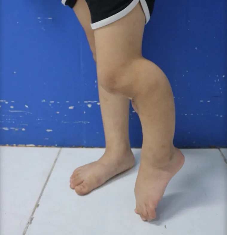 Nguy hiểm từ việc đắp lá chữa viêm xương - Ảnh 1.