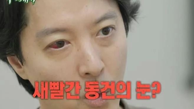 Xuất hiện với 1 mắt đỏ ngầu, Lee Dong Gun được chẩn đoán mắc căn bệnh hiếm - Ảnh 1.