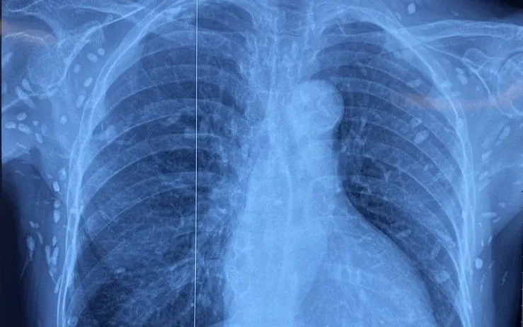 Nhiều nốt cản quang dưới da thành ngực-bụng và chi trên.