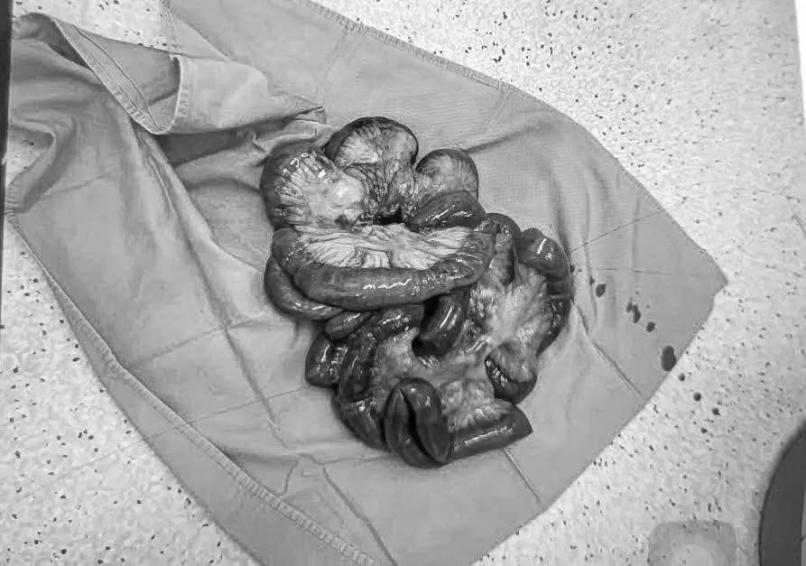 Cắt bỏ gần 5 mét ruột non hoại tử để cứu sống bệnh nhân- Ảnh 1.