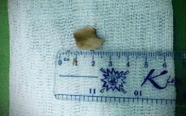 Gắp thành công mảnh xương sắc nhọn trong phế quản bệnh nhân 50 tuổi