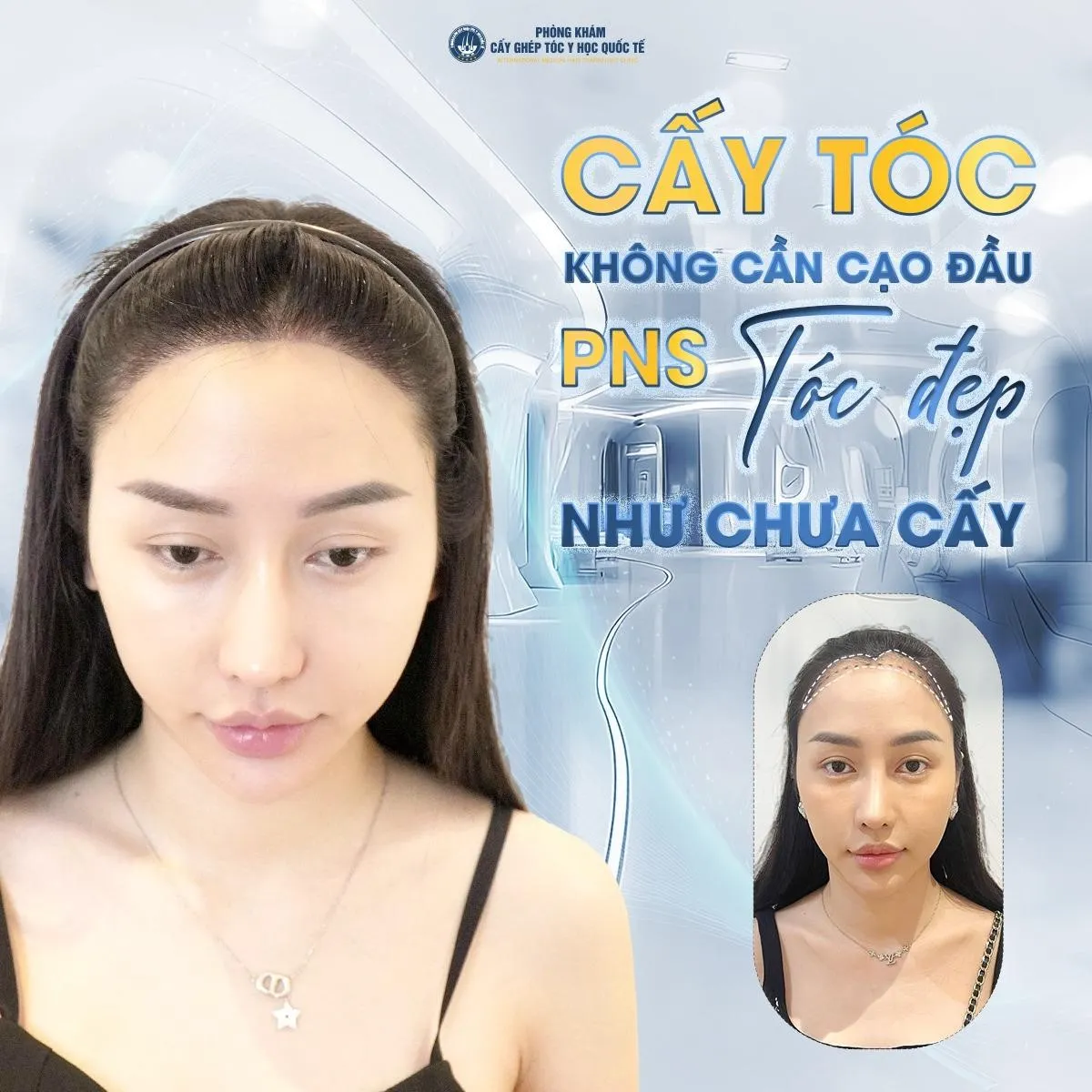 Những phương pháp cấy tóc mới nhất hiện nay tại Cấy tóc Y học Quốc tế - Ảnh 2.