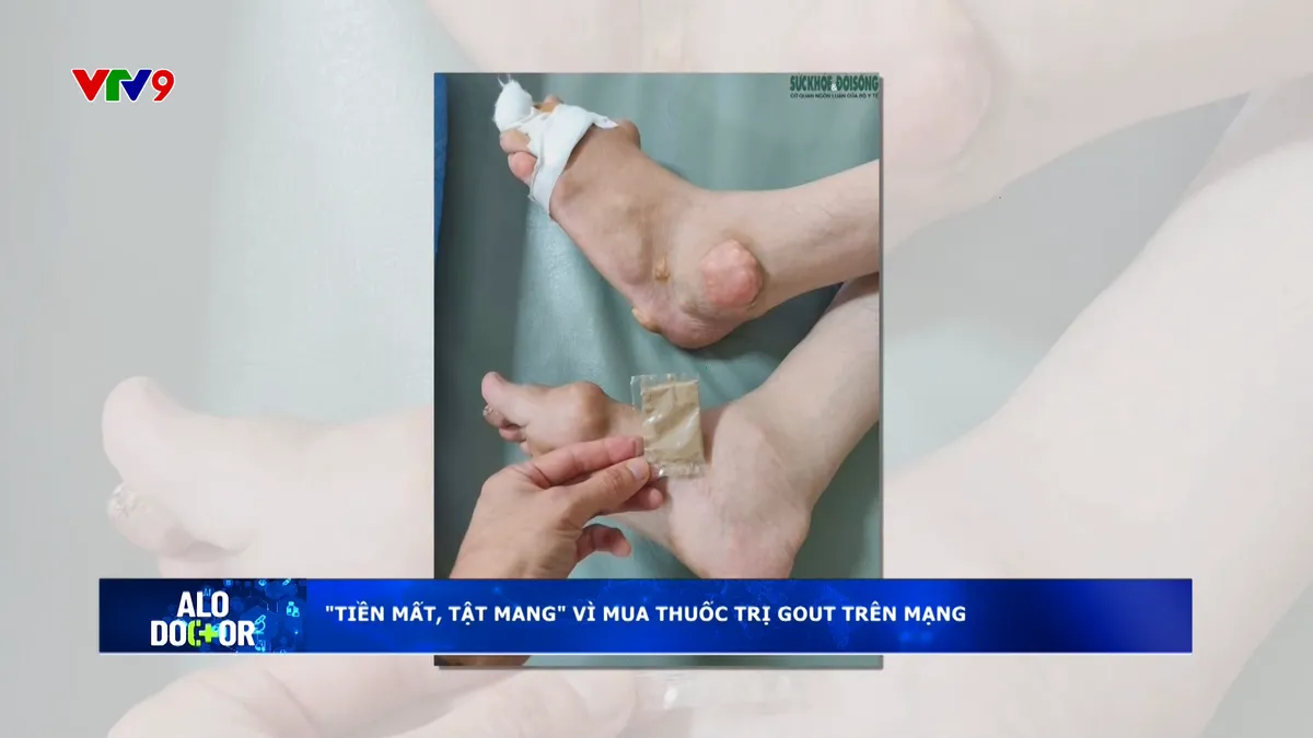 Alo Doctor (03/11/2025): "Tiền mất, tật mang" vì mua thuốc trị gout trên mạng