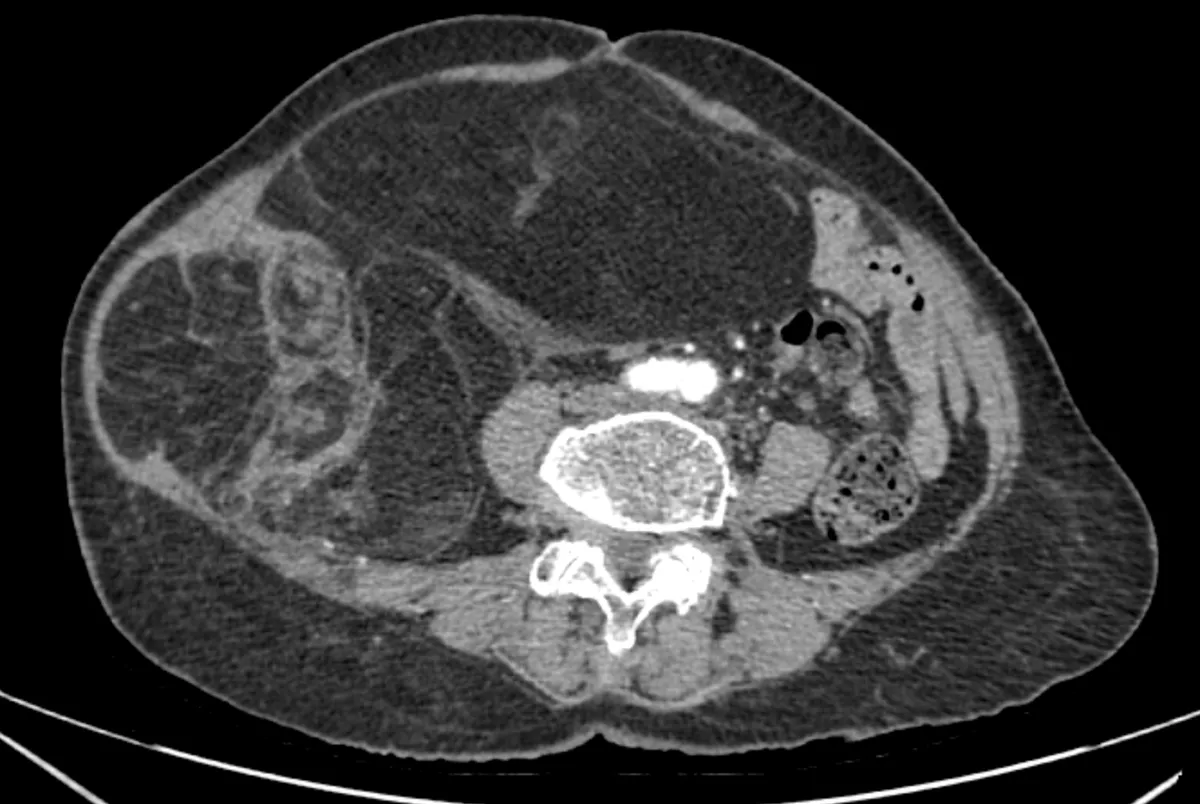 Phẫu thuật thành công khối Sarcoma mỡ sau phúc mạc khổng lồ ở bệnh nhân 76 tuổi- Ảnh 1. Phẫu thuật thành công khối Sarcoma mỡ sau phúc mạc khổng lồ ở bệnh nhân 76 tuổi- Ảnh 1.