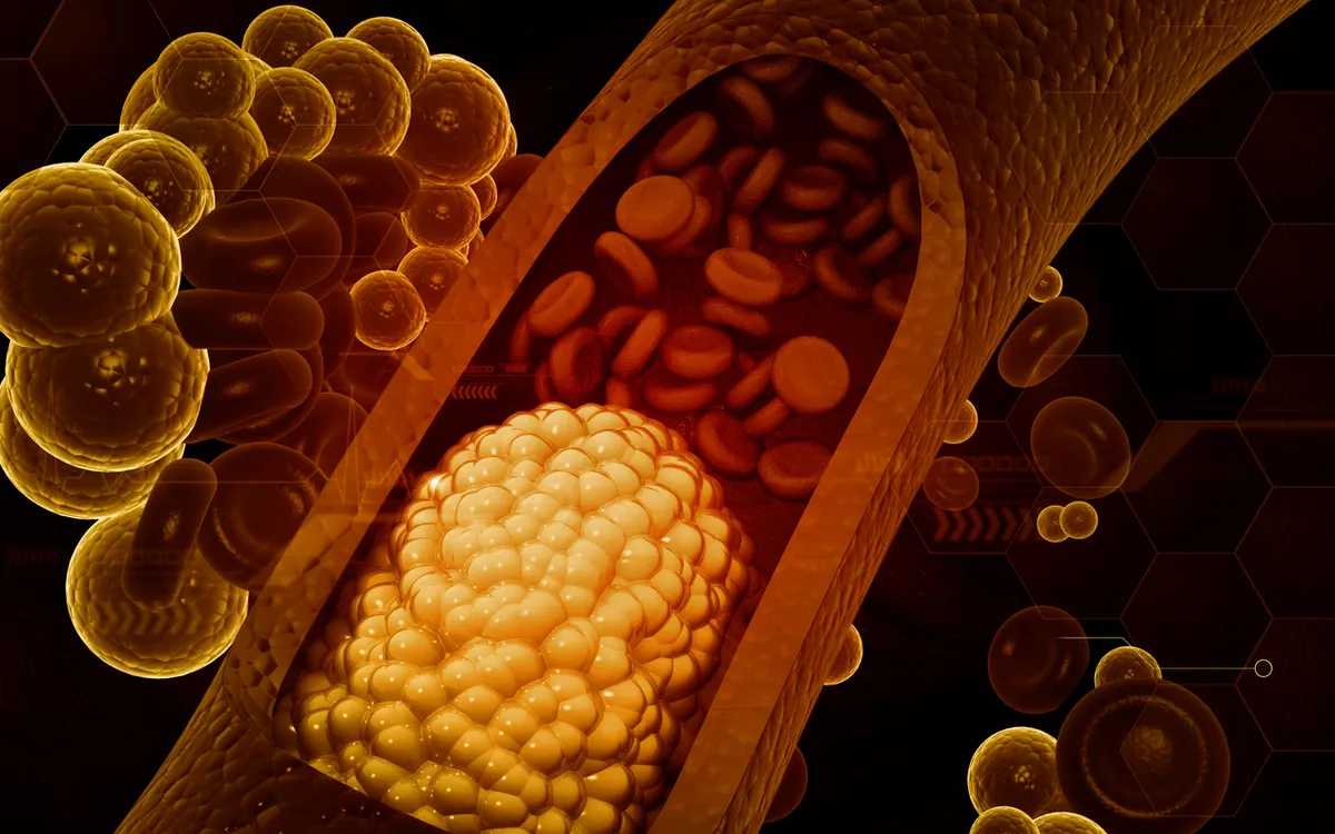 Cholesterol cao làm tăng nguy cơ mắc tim mạch, nguyên nhân tử vong hàng đầu trên toàn cầu (Ảnh minh họa: Getty Images)