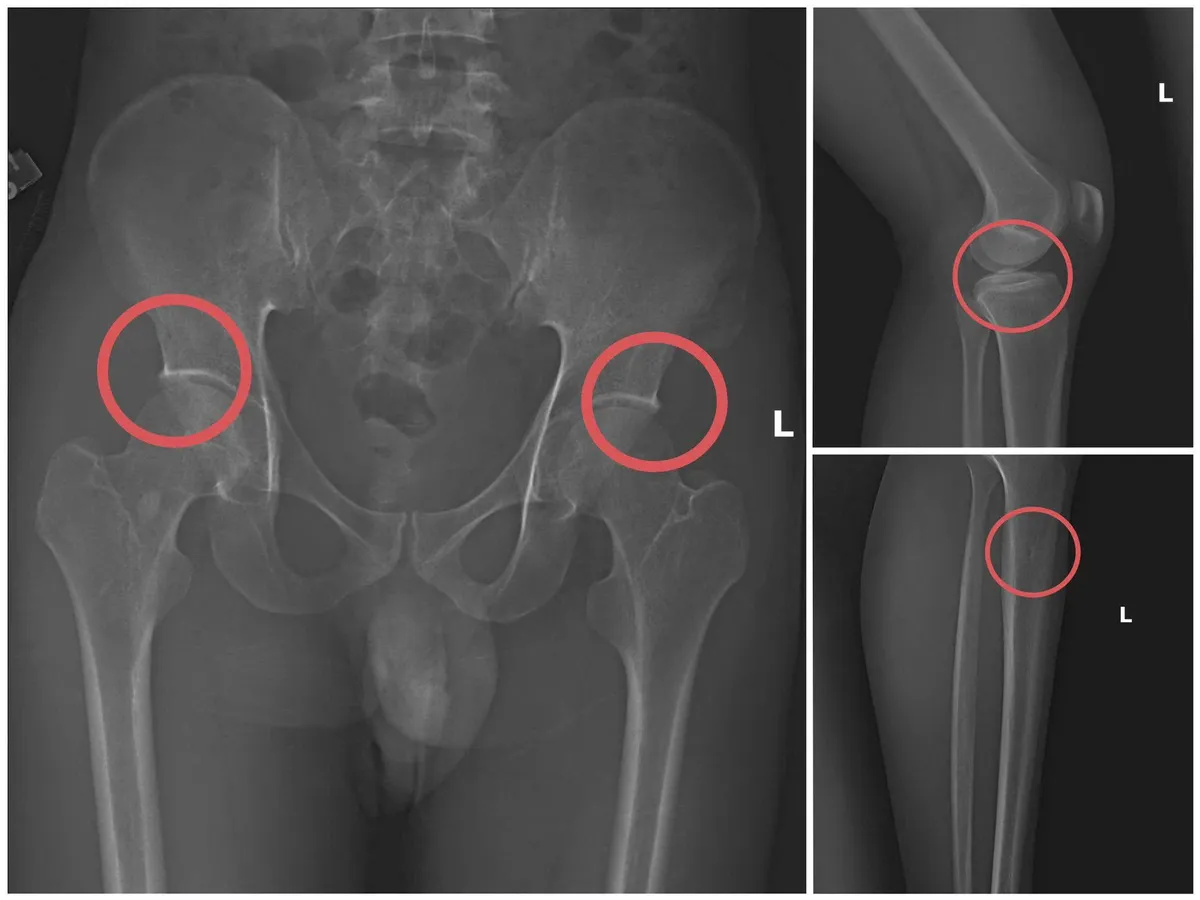 Phú Thọ: Triệt phá đường dây trục lợi bảo hiểm hiểm nhân thọ bằng cách tự đục vỡ xương - Ảnh 3.