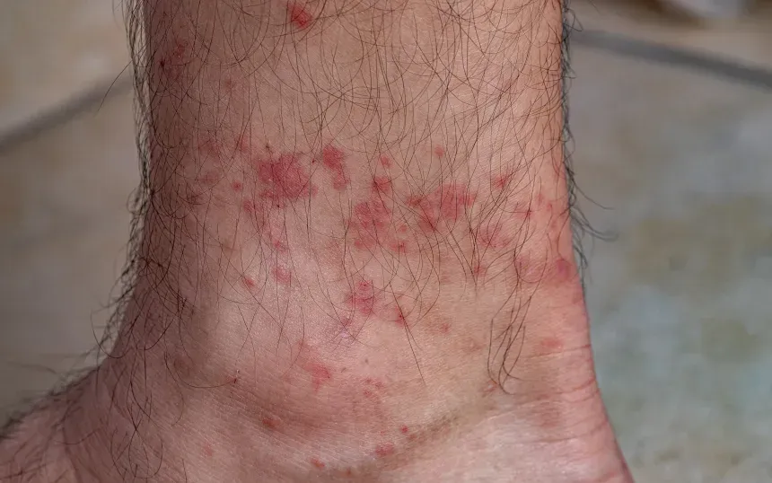 Tránh bị ve cắn là cách tốt nhất để ngăn ngừa hội chứng alpha-gal (Ảnh: iStock/Getty Images)