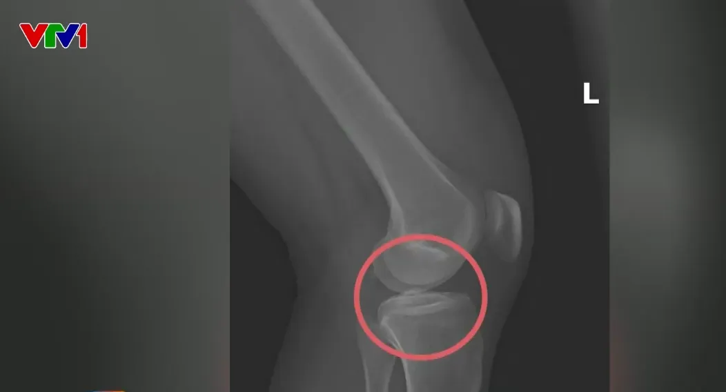 Tự đục vỡ xương khớp để trục lợi bảo hiểm: Thủ đoạn tàn nhẫn, vô nhân tính - Ảnh 1.