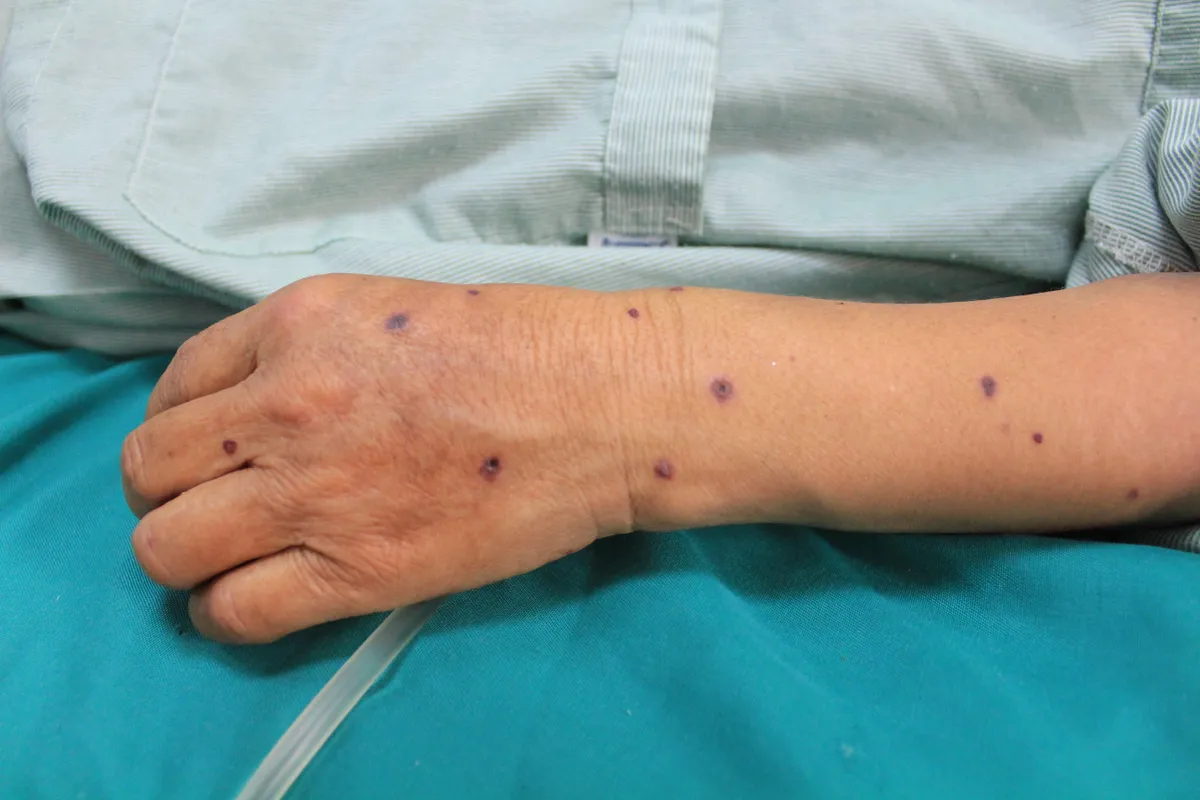 Nguy kịch vì bị ong vò vẽ đốt hơn 80 vết, bác sĩ cảnh báo nguy cơ suy thận và tử vong- Ảnh 1. Nguy kịch vì bị ong vò vẽ đốt hơn 80 vết, bác sĩ cảnh báo nguy cơ suy thận và tử vong- Ảnh 1.