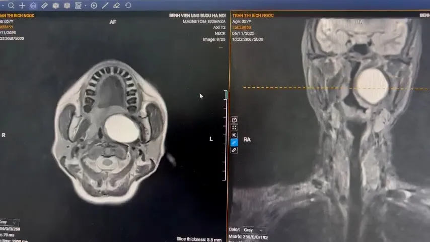 Ứng dụng kỹ thuật mới trong phẫu thuật nội soi bóc tách u khoang bên họng- Ảnh 1.
