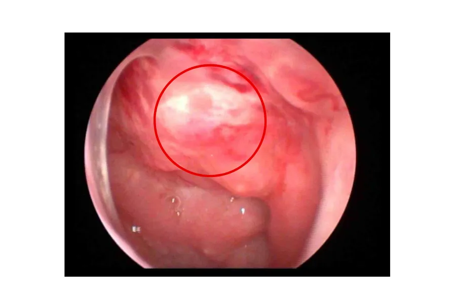 Phát hiện kịp thời ung thư vòm từ dấu hiệu ù tai- Ảnh 1. Phát hiện kịp thời ung thư vòm từ dấu hiệu ù tai- Ảnh 1.