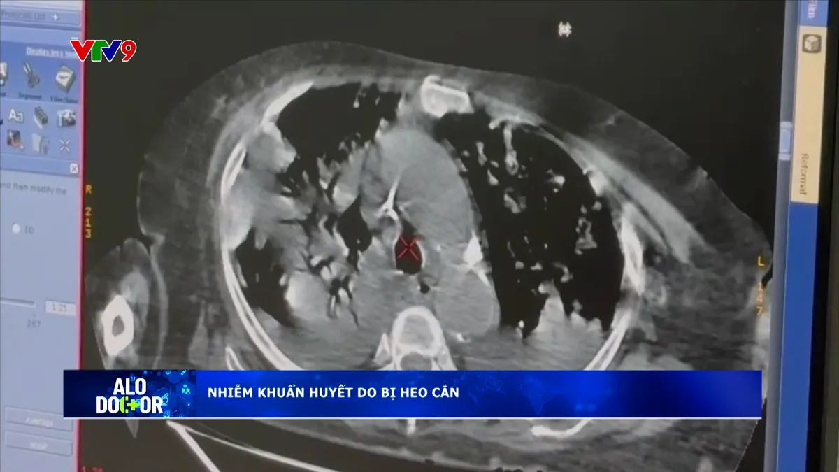 Alo Doctor (27/11/2025): Nhiễm khuẩn huyết do bị heo cắn