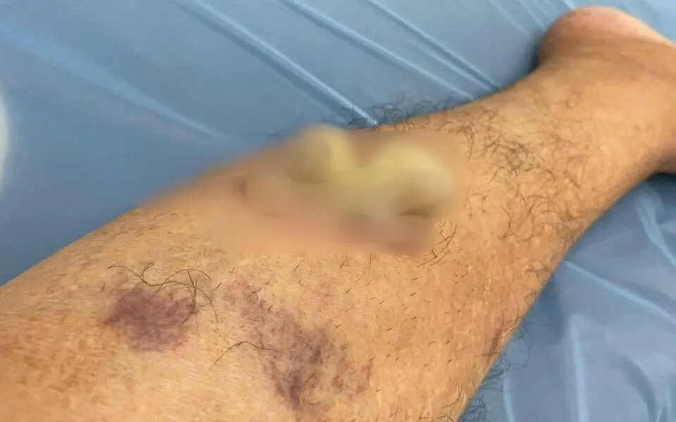 Hình ảnh khối u nhú tế bào gai sừng hóa của bệnh nhân trước khi nhập viện.