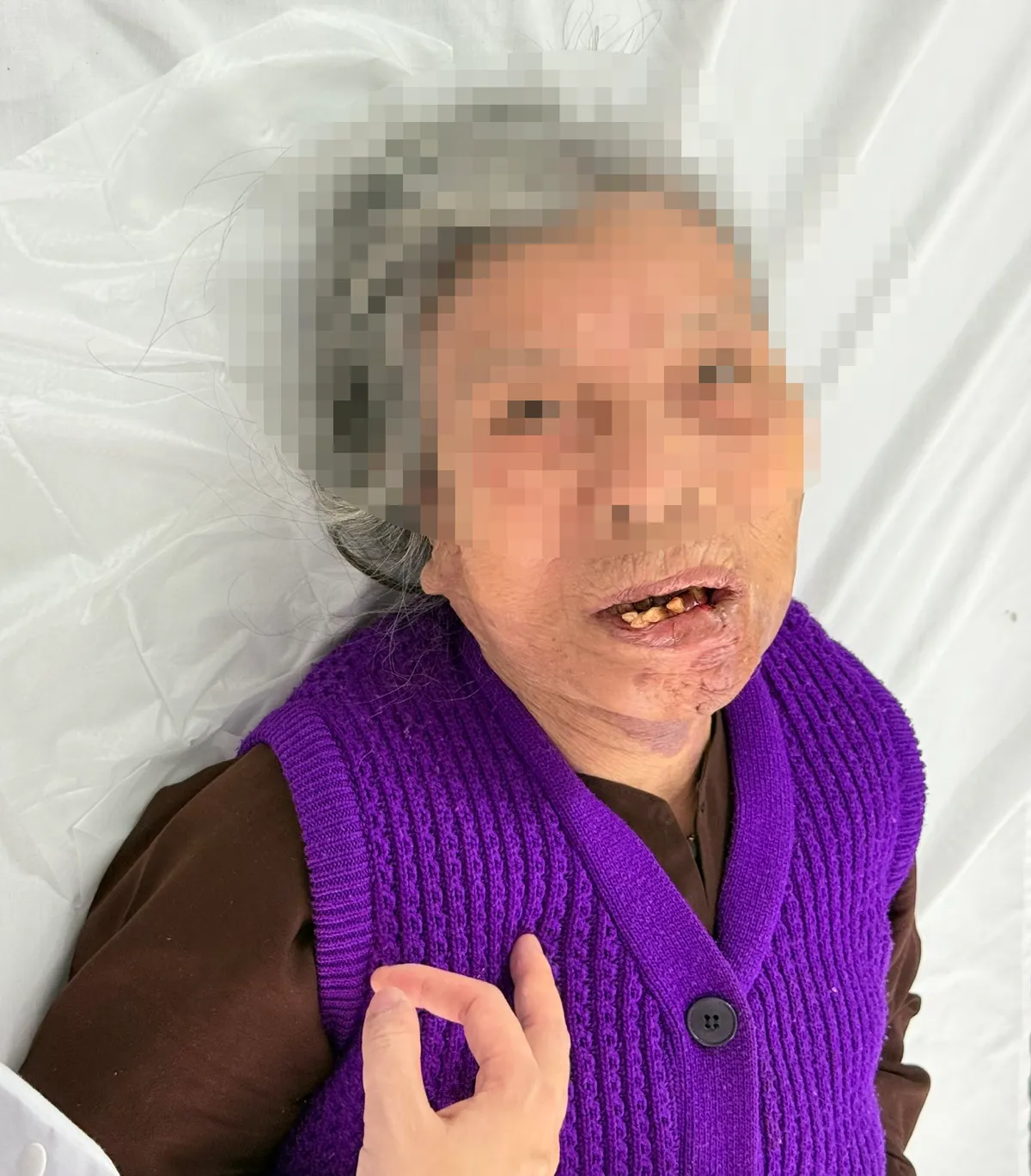 Phẫu thuật thành công khối u mạch kích thước lớn vùng môi đã hoại tử nghiêm trọng- Ảnh 2. Phẫu thuật thành công khối u mạch kích thước lớn vùng môi đã hoại tử nghiêm trọng- Ảnh 2.