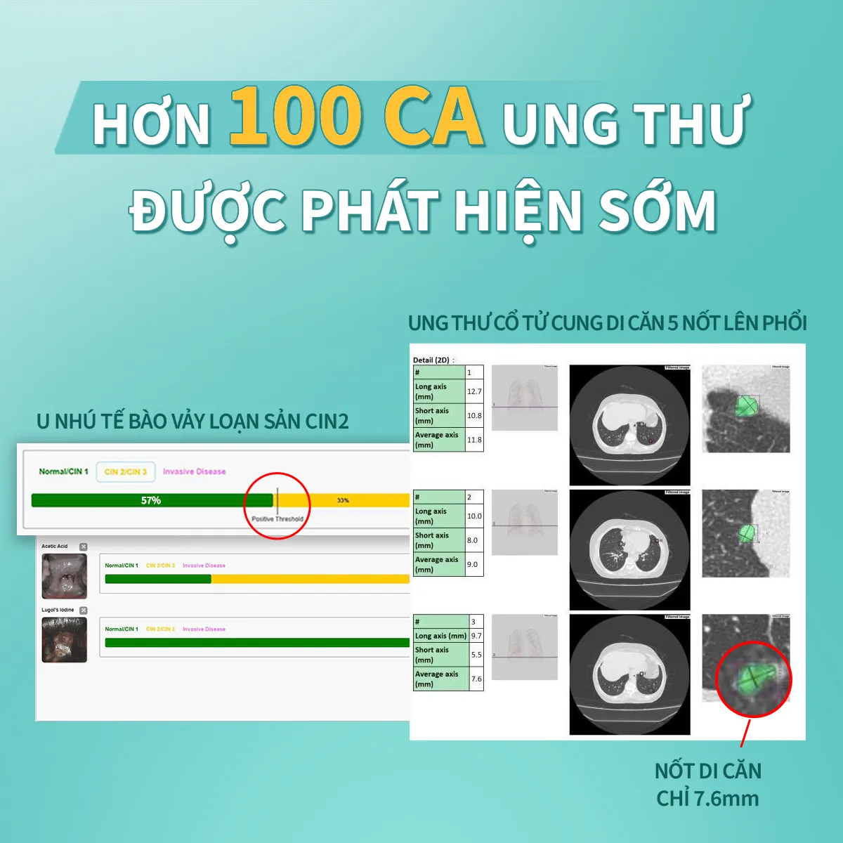 Ứng dụng AI trong tầm soát sức khỏe: Lời giải cho bài toán phát hiện sớm ung thư tại Việt Nam- Ảnh 3. Ứng dụng AI trong tầm soát sức khỏe: Lời giải cho bài toán phát hiện sớm ung thư tại Việt Nam- Ảnh 3.