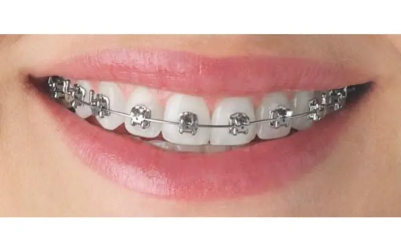 Bọc răng sứ có niềng răng được không? Nha Khoa Đăng Lưu giải đáp- Ảnh 1. Bọc răng sứ có niềng răng được không? Nha Khoa Đăng Lưu giải đáp- Ảnh 1.