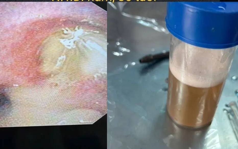 Viêm phổi nặng do sặc dầu, bác sĩ cảnh báo nguy cơ suy hô hấp