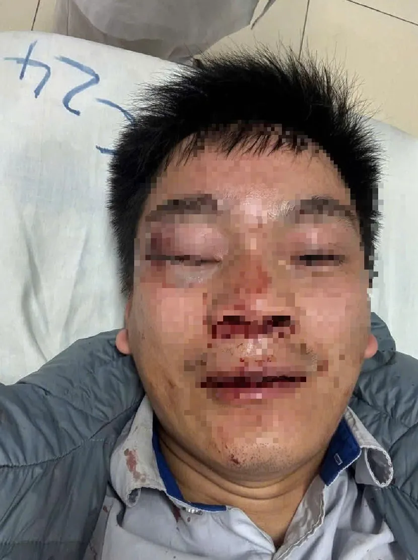 L&aacute;i xe bu&yacute;t bị h&agrave;nh hung phải nhập viện cấp cứu- Ảnh 1.