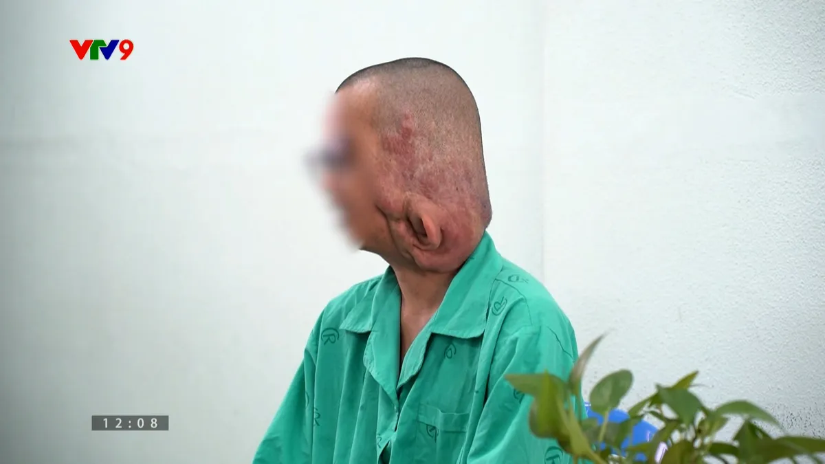 Cắt bỏ thành công khối u sợi khổng lồ trên mặt bệnh nhân