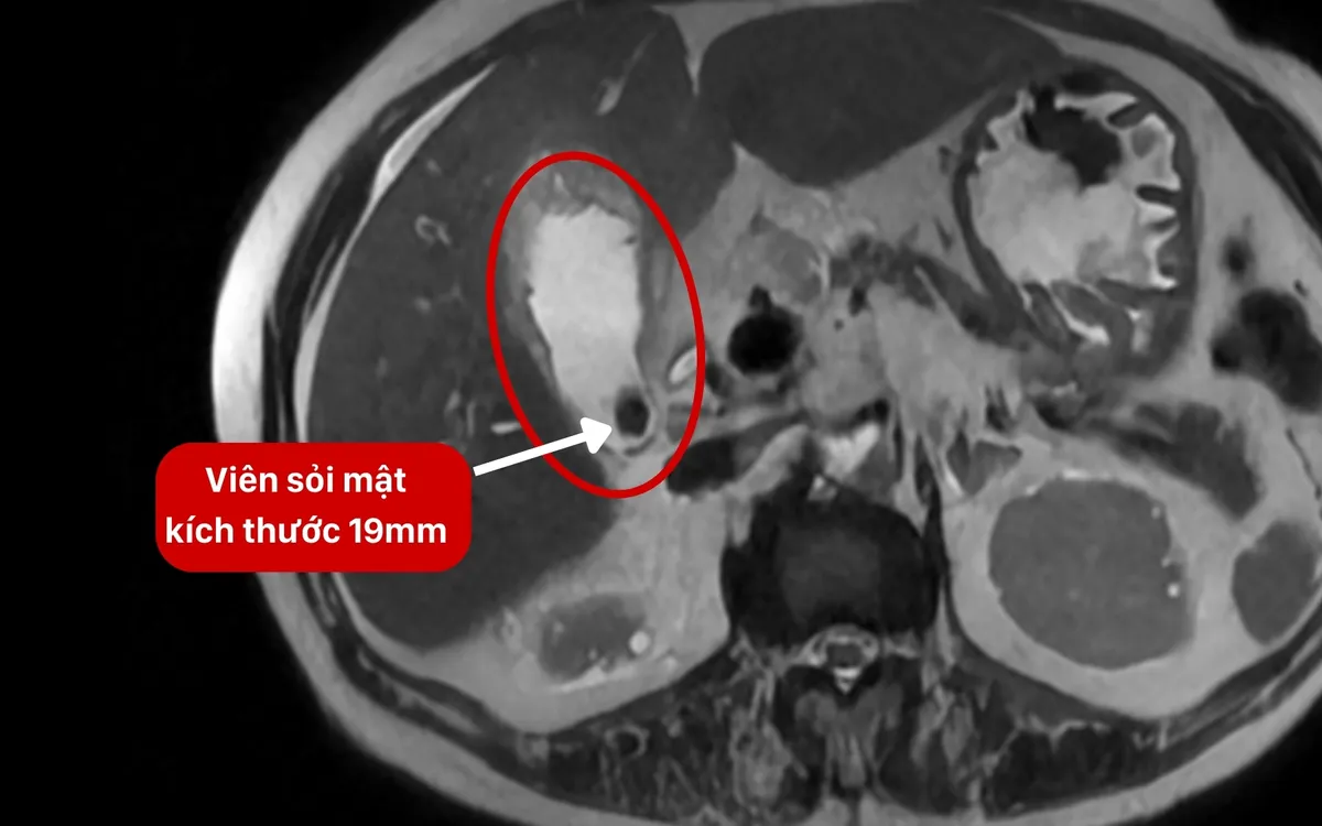 Sỏi mật 19mm khiến cụ b&agrave; 82 tuổi nhiễm khuẩn huyết- Ảnh 1.