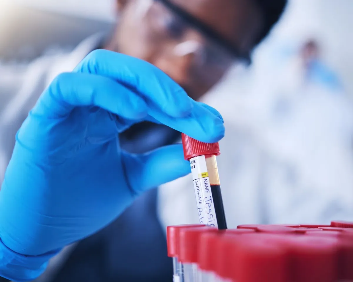 X&eacute;t nghiệm m&aacute;u c&oacute; thể dự b&aacute;o nguy cơ biến chứng ở người mắc bệnh cơ tim ph&igrave; đại - Ảnh 1.