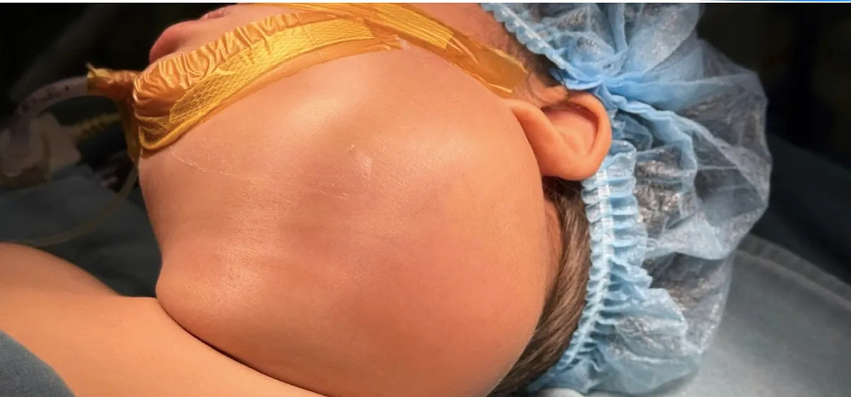 Cắt bỏ khối u nang bạch huyết khổng lồ cứu b&eacute; g&aacute;i 2 tuổi- Ảnh 1.