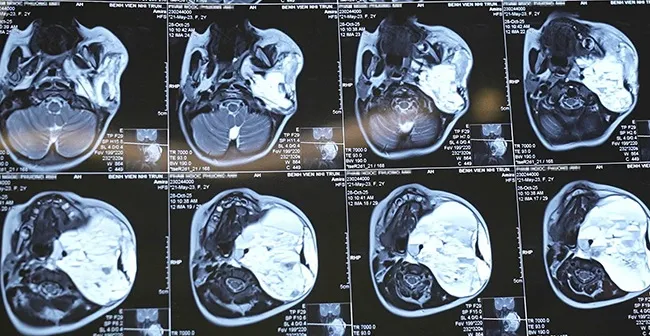 Cắt bỏ khối u nang bạch huyết khổng lồ cứu b&eacute; g&aacute;i 2 tuổi- Ảnh 2.