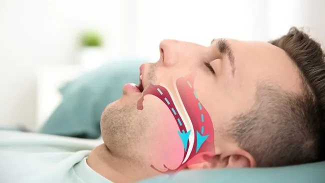 Hội chứng ngưng thở khi ngủ kẻ sát nhân thầm lặng đêm khuya- Ảnh 1. Hội chứng ngưng thở khi ngủ kẻ sát nhân thầm lặng đêm khuya- Ảnh 1.