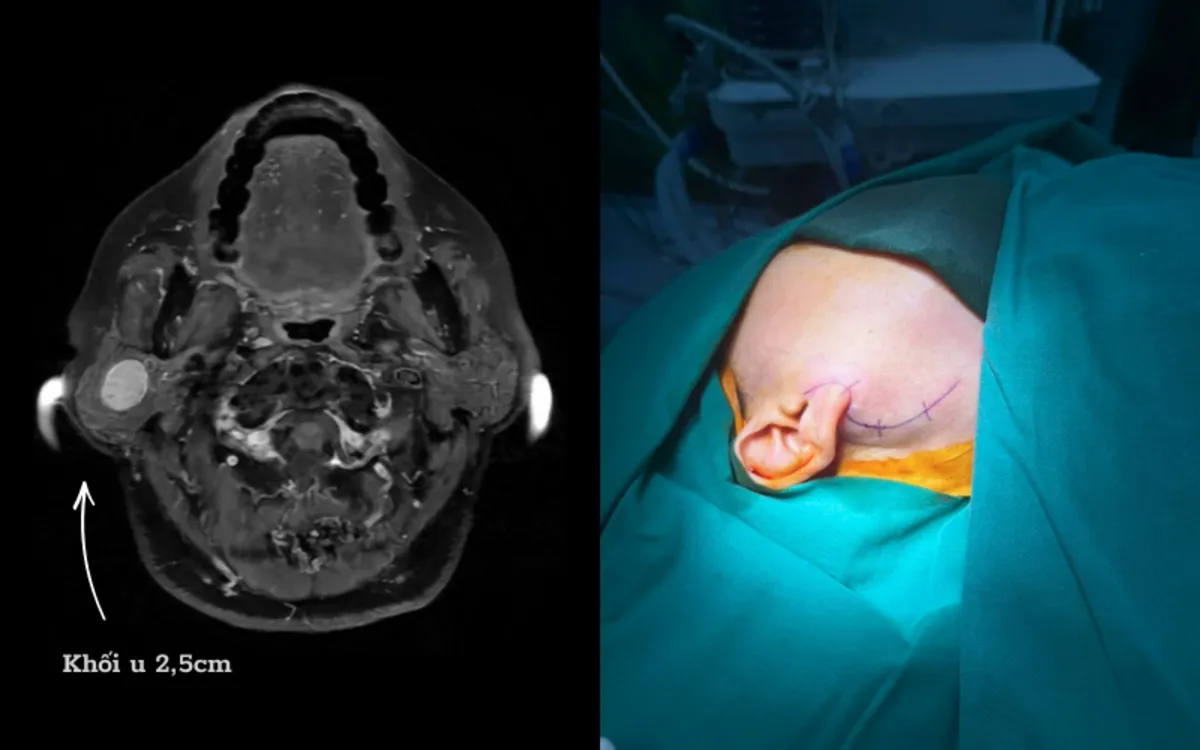 Loại bỏ nguy cơ liệt mặt nhờ m&aacute;y d&ograve; thần kinh- Ảnh 1.