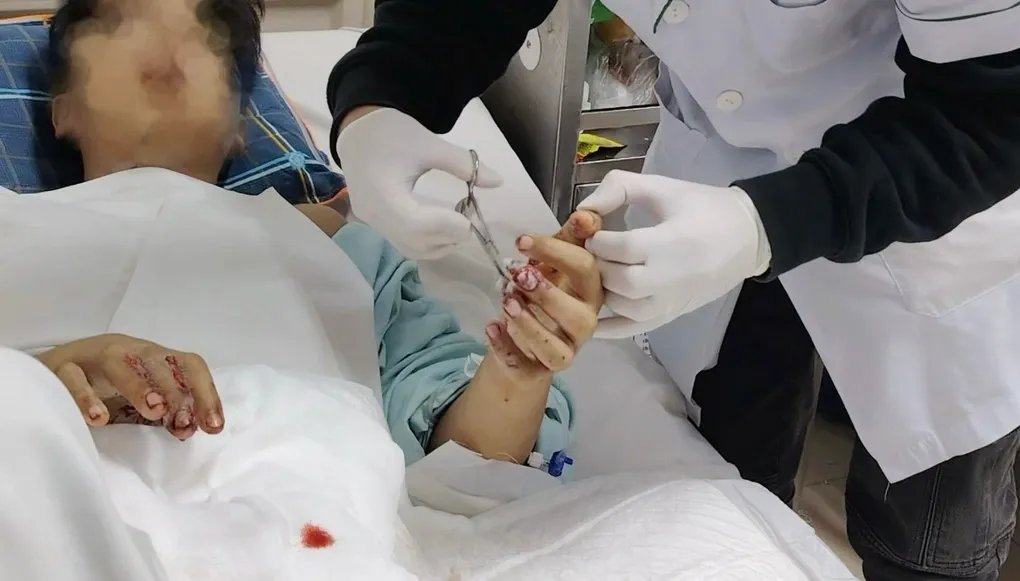 Li&ecirc;n tiếp ca cấp cứu nghi&ecirc;m trọng v&igrave; ph&aacute;o nổ, c&oacute; bệnh nhi 15 tuổi- Ảnh 1.